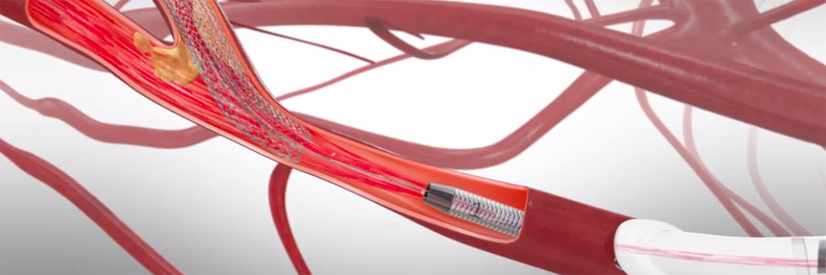 Our Technology - Trans Carotid Artery Revascularization (TCAR)
