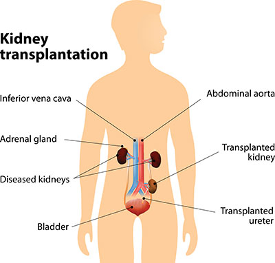 Kidney-Transplant