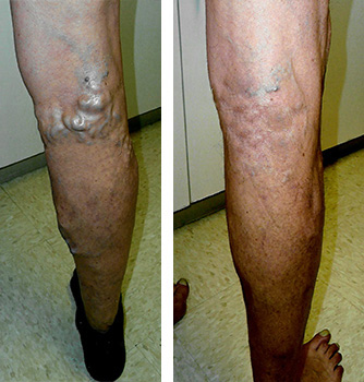 Varicose Veins Before & After