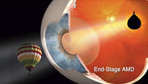 Telescopic Surgery for Macular Degeneration