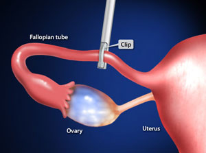 Tubal Ligation (Laparoscopic Tubal Clip Sterilization) - Willis-Knighton  Health System