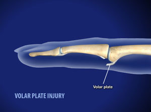 Volar Plate Injuries - Willis-Knighton Health System - Shreveport ...