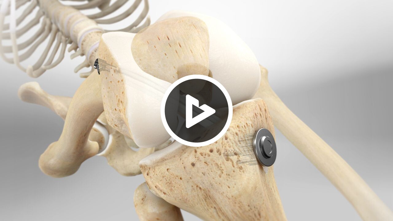 Hamstring Acl Device ACL Reconstruction (Hamstring Graft Method With EZLoc™ Femoral Fixation ...