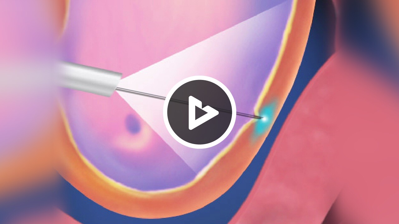 Firefly Injection Bladder Botulinum Toxin (BOTOX®) Injections for Overactive Bladder (Female ...