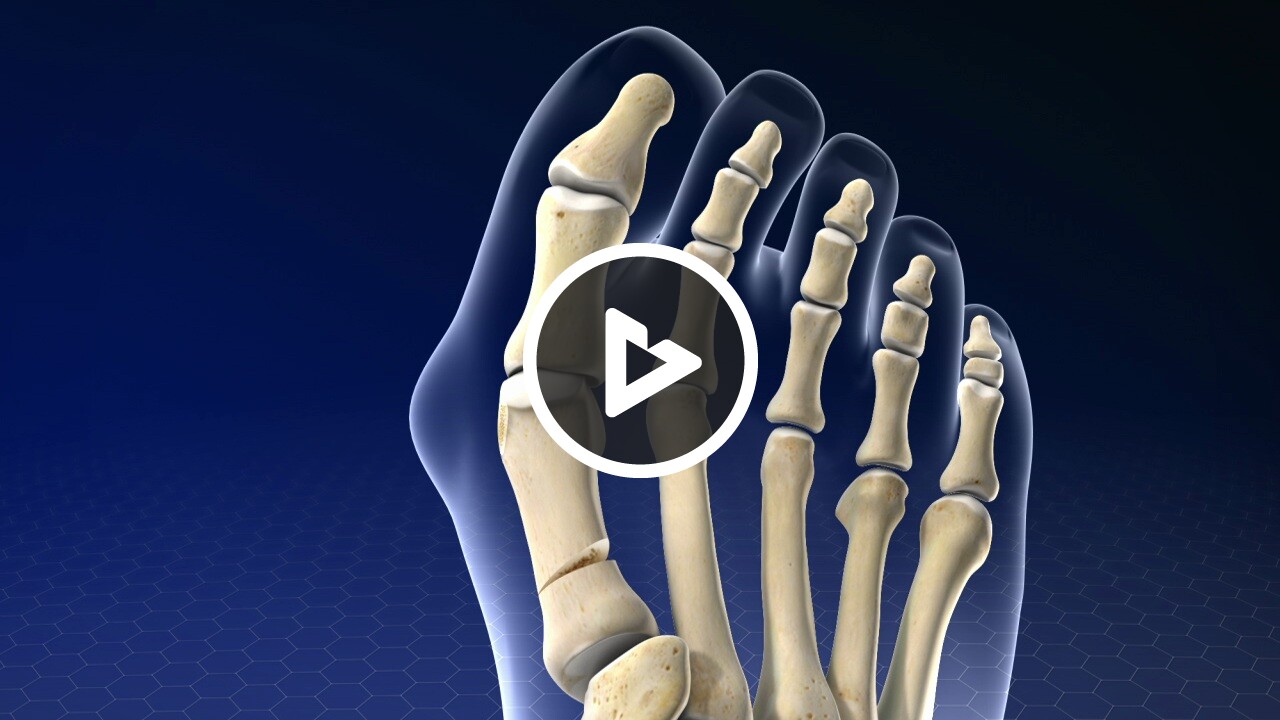 Toe Realignment Surgery Bunionectomy With Wedge Osteotomy - Health Resources - Willis Knighton ...