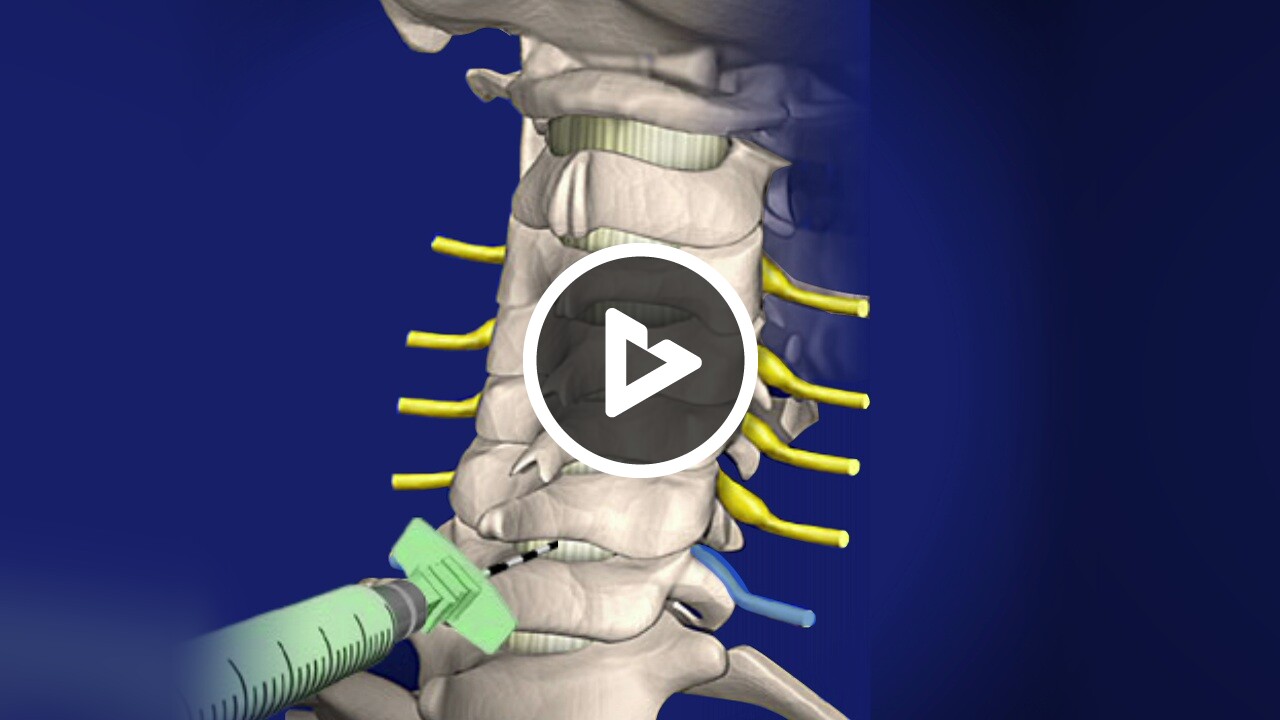 Cervical Epidural Steroid Injection (without contrast) - Health ...
