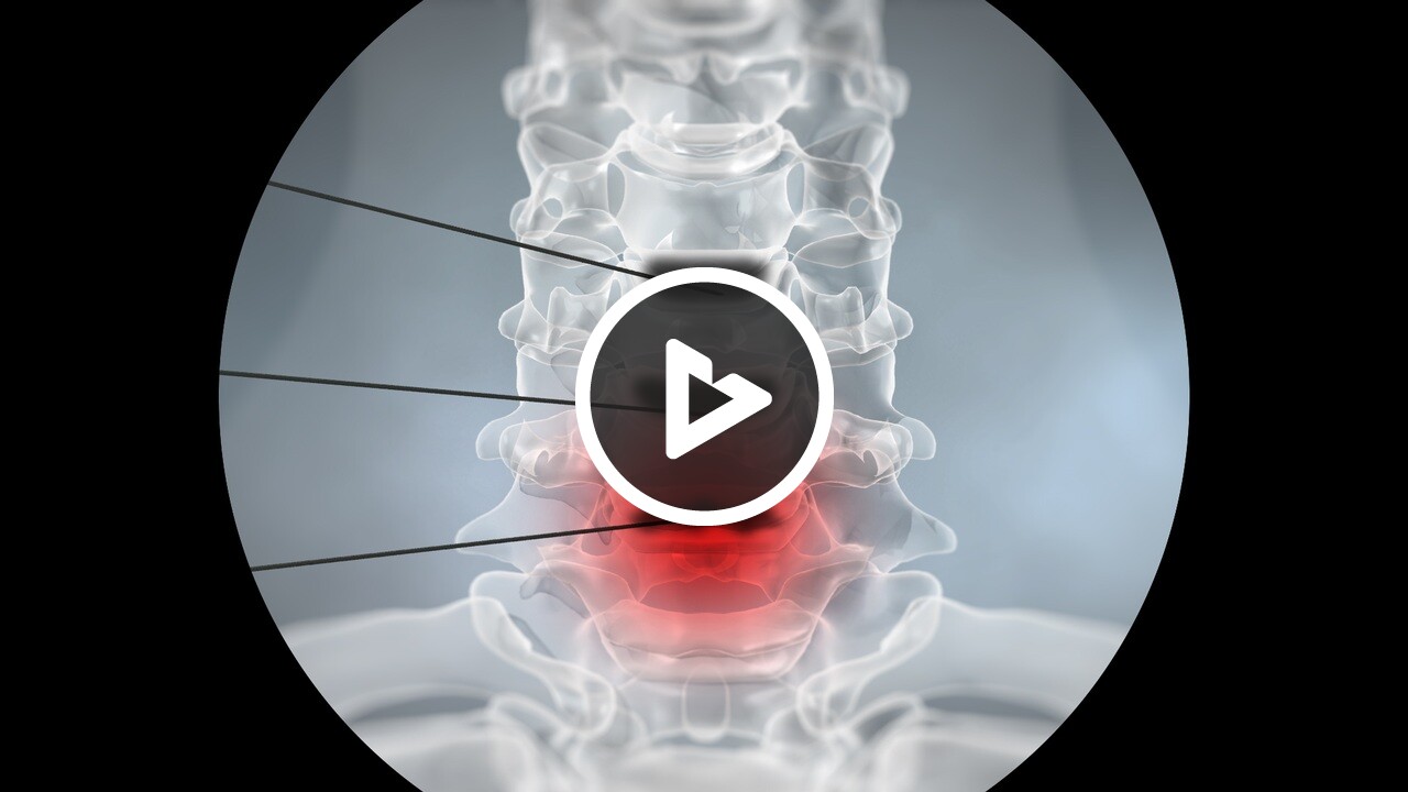 Discography (Cervical) - Medical Procedures, Tests, Care and Management ...