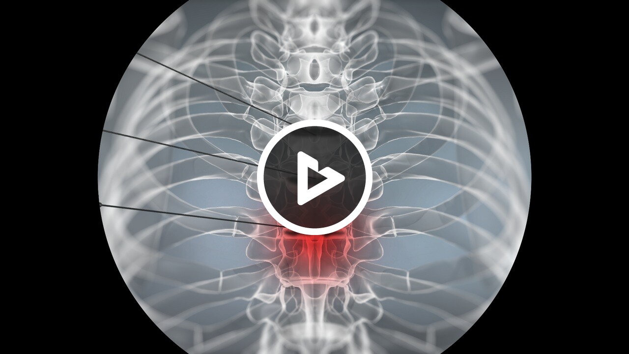 Discography (Lumbar) - Medical Procedures, Tests, Care and Management ...