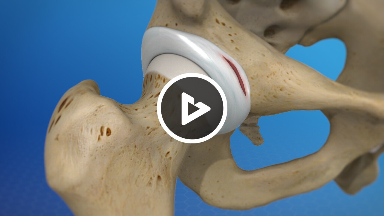 Labral Tear of the Hip (Acetabular Labrum Tear) - Disease & Condition  Information - Willis Knighton Health - Top Hospitals and Doctors in  Shreveport