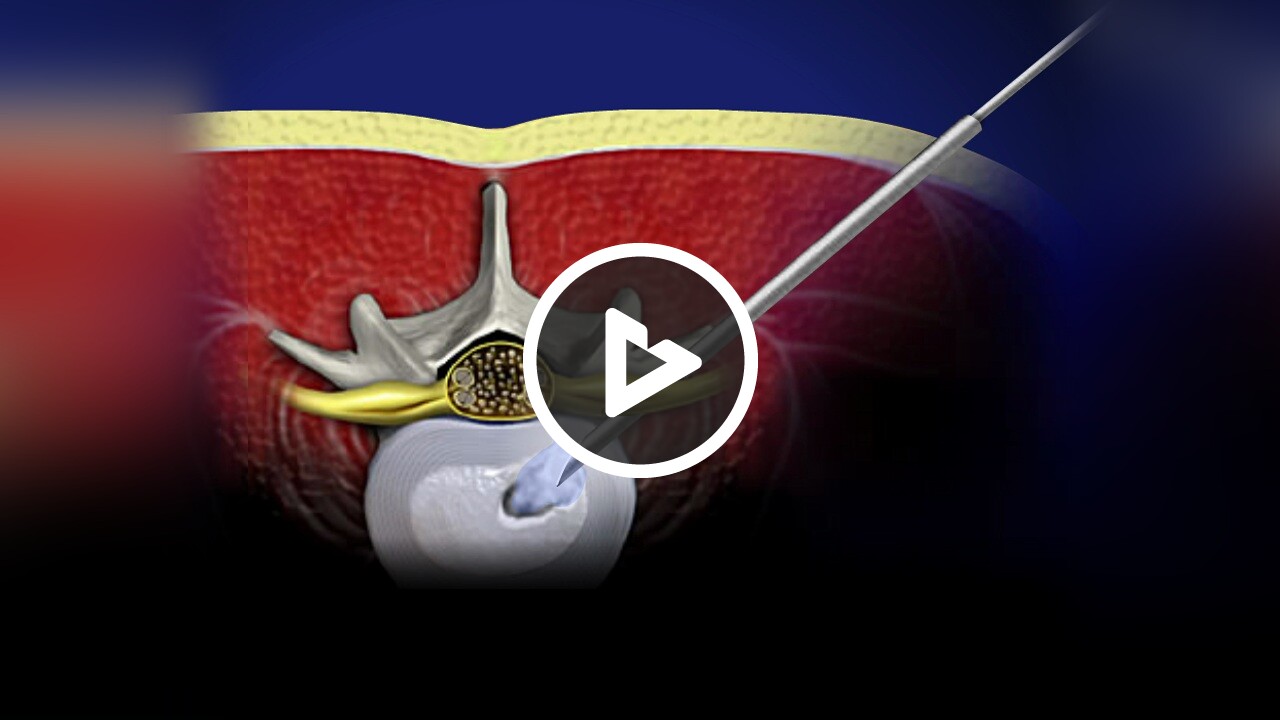 Lumbar Discoscopic Discectomy - Medical Procedures, Tests, Care and ...