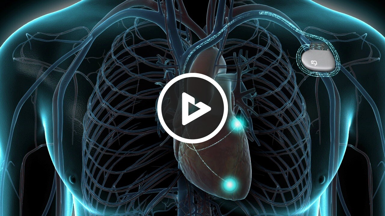 Intravascular Pacemaker Pacemaker Implantation (Endocardial Approach) - Medical Procedures ...