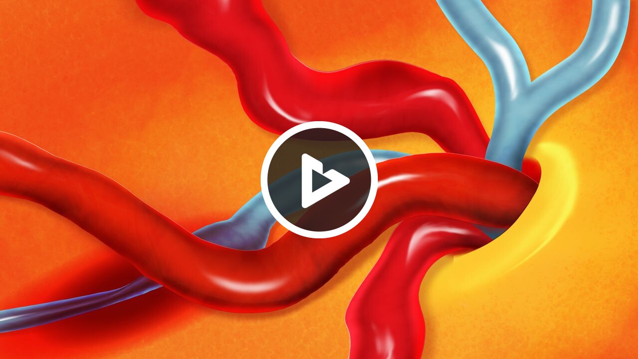 Rvo Retinal Vein Occlusion (RVO) - Disease & Condition Information - Willis ...