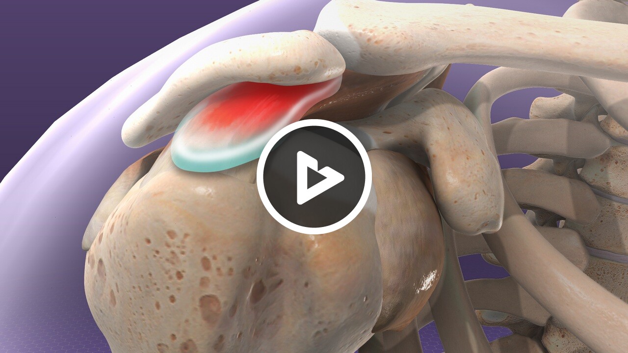 shoulder impingement bpc 157 Syndrome - Shoulder and Elbow - Willis Knighton Health - Top Hospitals and Doctors in Shreveport bvitamins