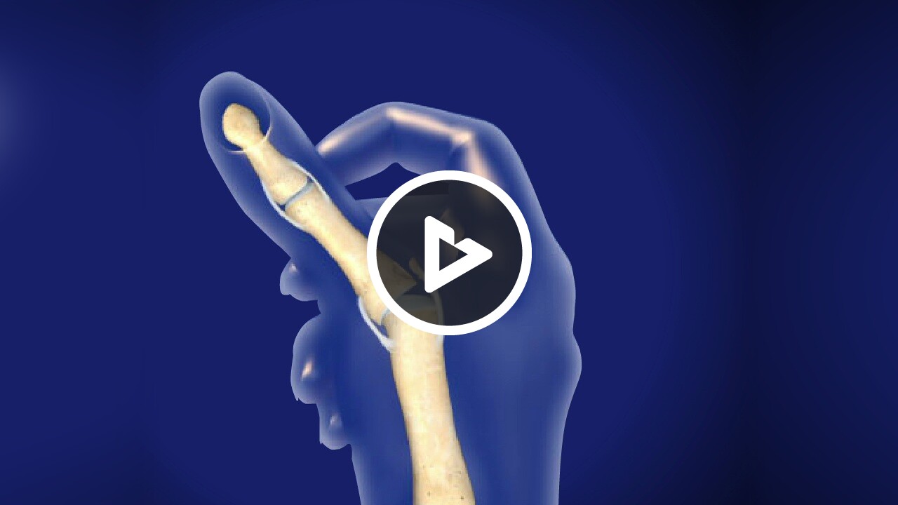 Thumb Sprain (UCL Injury of the Thumb) - Health Resources - Willis ...