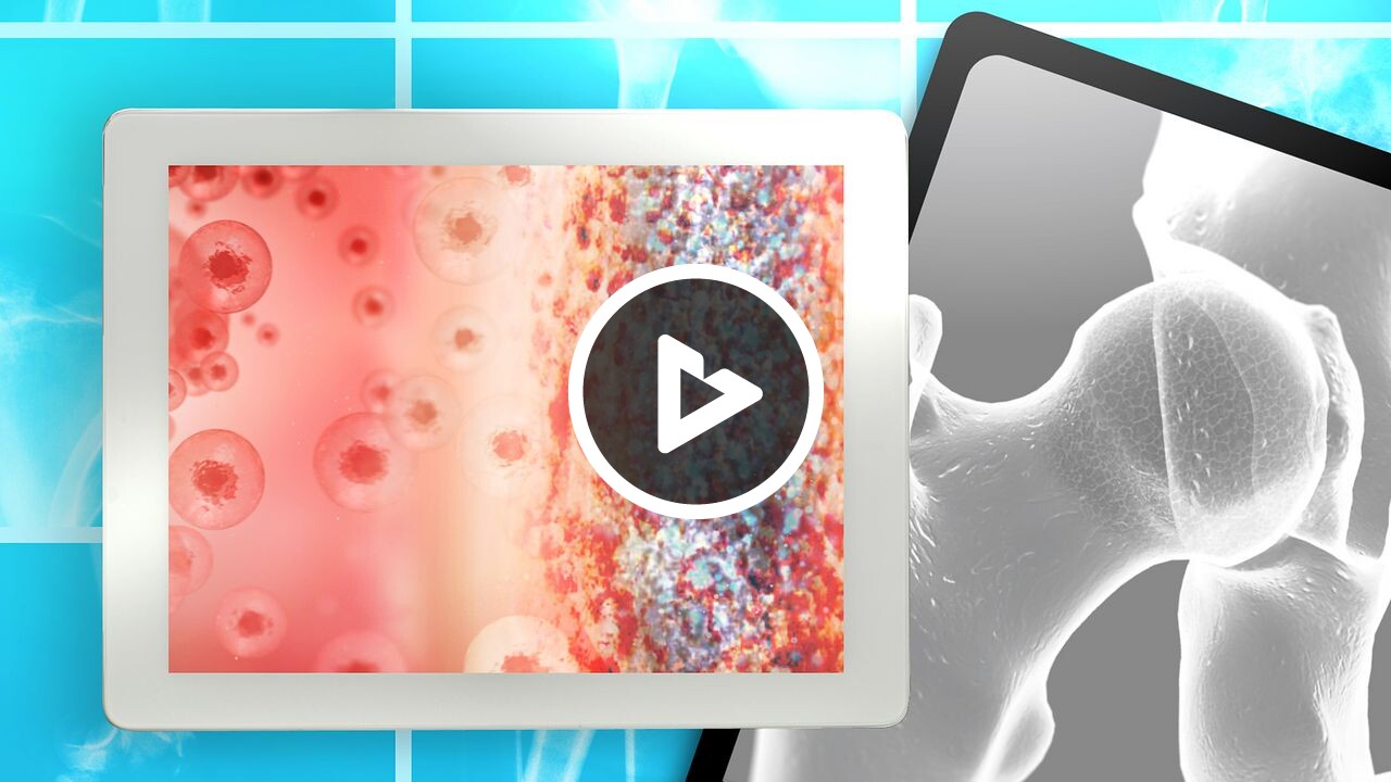Stem Cell Therapy for Avascular Necrosis of the Hip - Health Resources ...