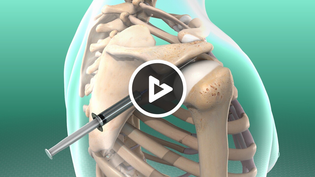 shoulder joint pain after b12 injection Vaccination: When to Seek Help Anyone had b12 injections and