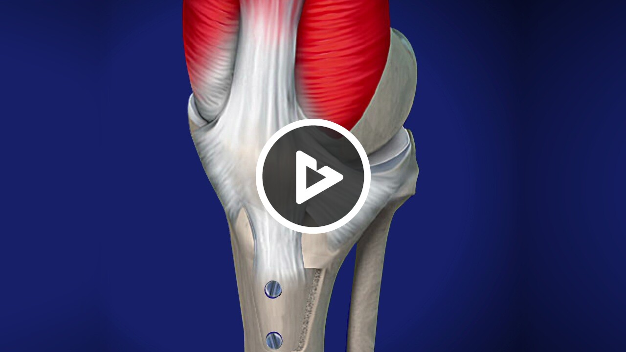 Tibia Salida Tibial Tubercle Osteotomy Cpt