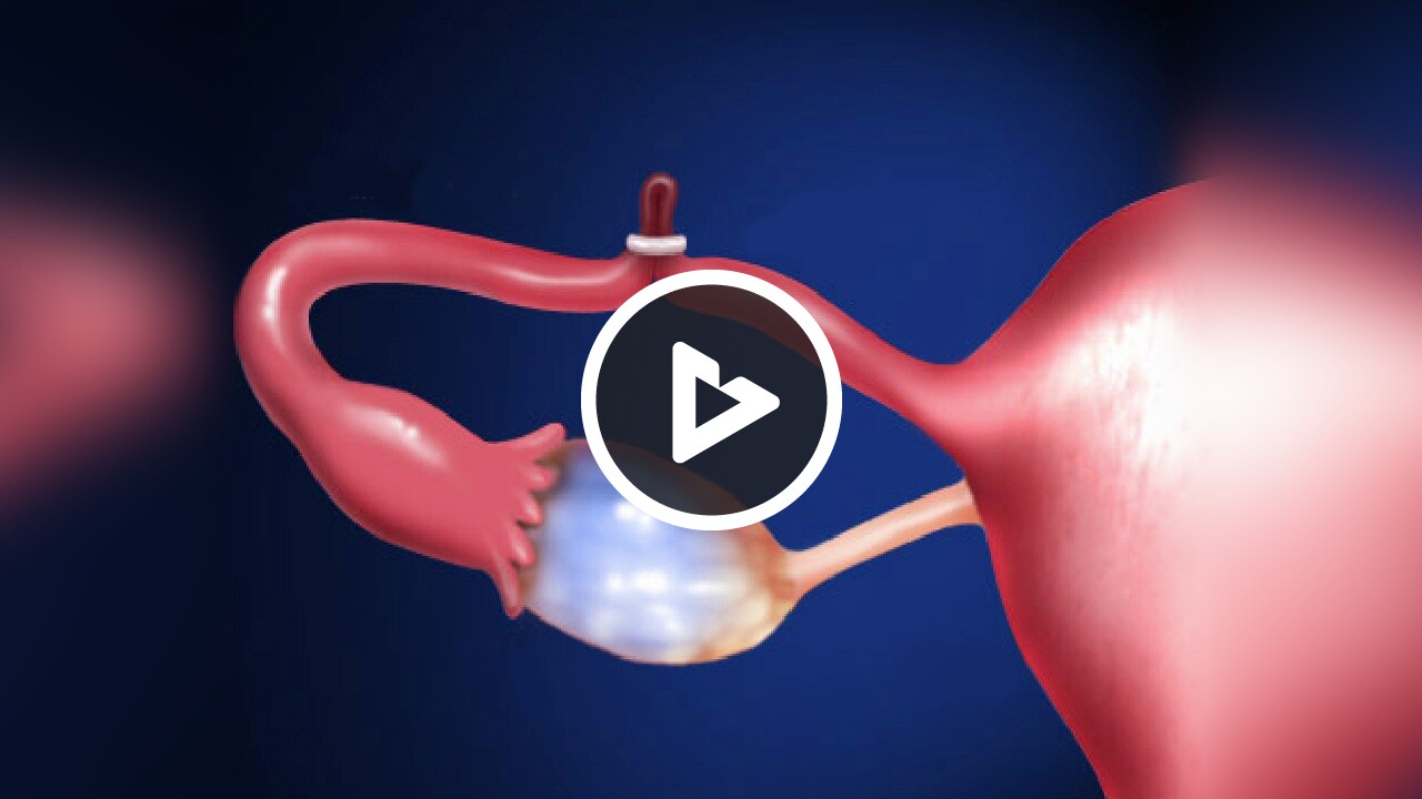 Tubal Ligation (Laparoscopic Tubal Ring Method) - Health Resources ...