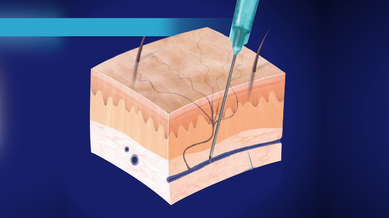 Sclerotherapy Vein Treatment