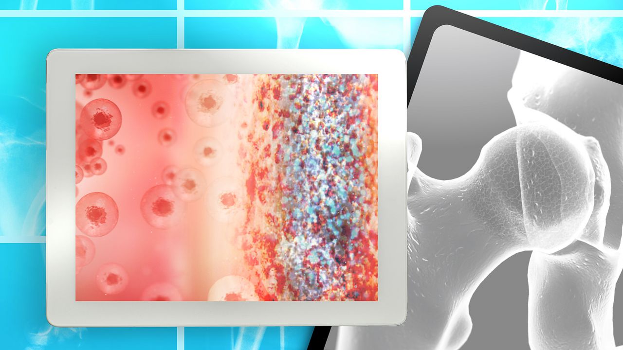 stemcellavascnecrosis_1280