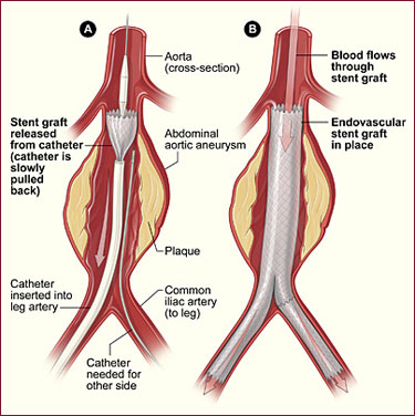 endovascular stent graft