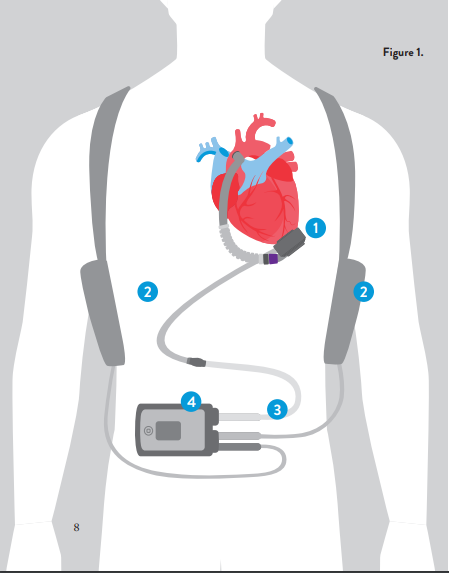 LVAD-Person LVAD
