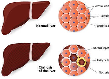 Liver Transplant
